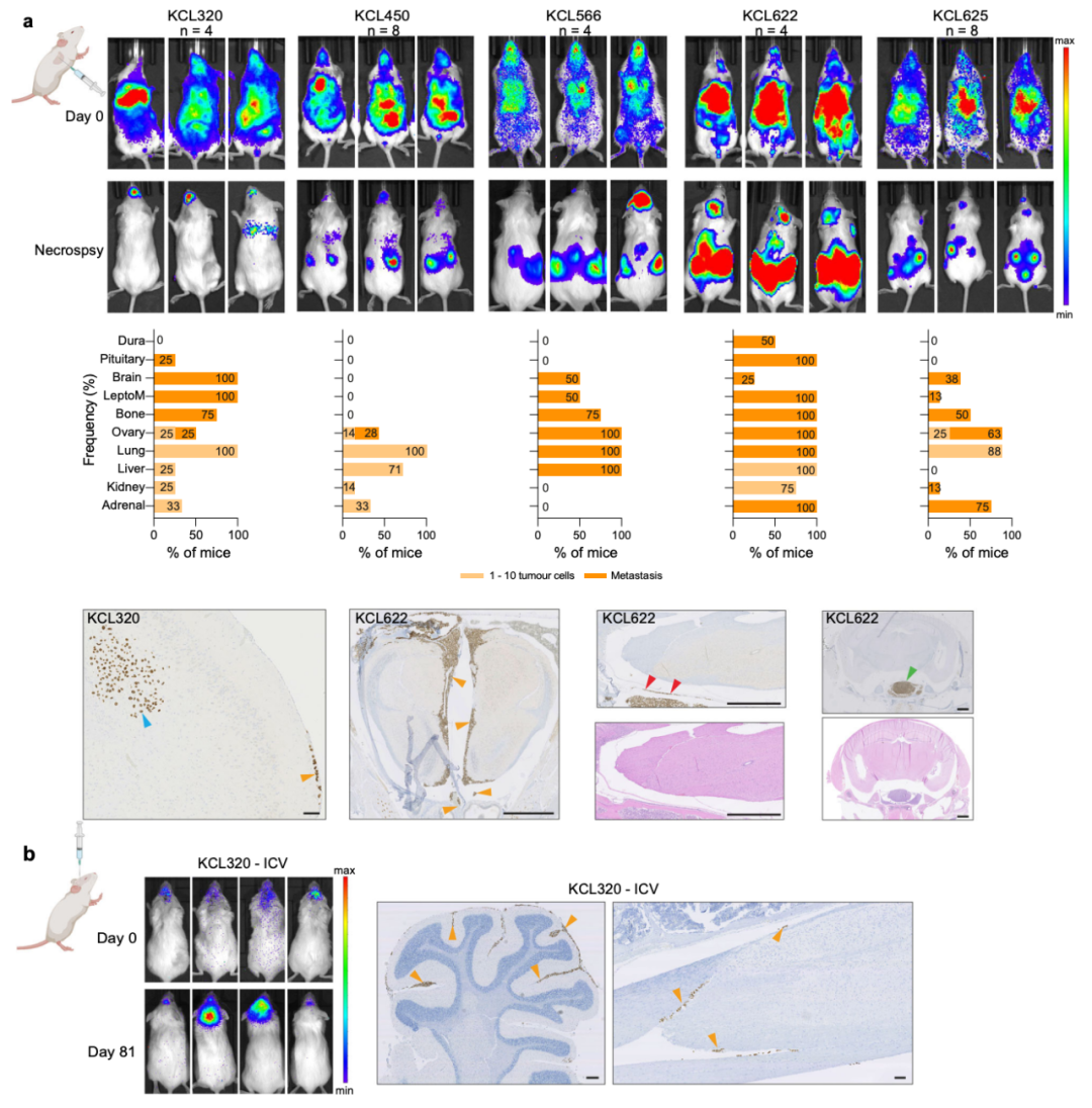 Nature子刊：患者來源的類器官，為乳腺癌腦轉移帶來新見解